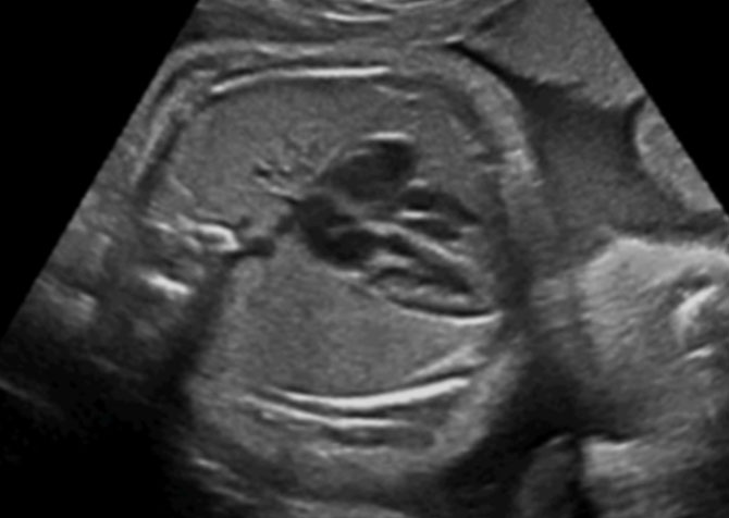 ECOCARDIOGRAFIA FETAL